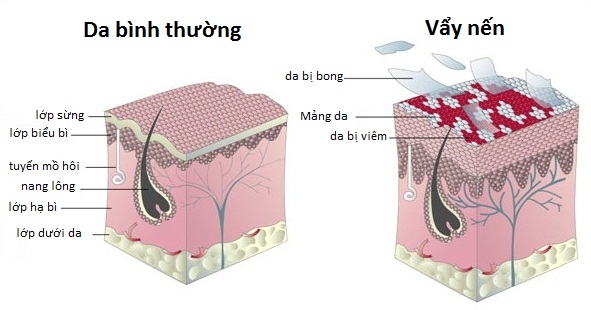 Bệnh vẩy nến khiến cho làn da bong tróc