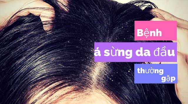 Nguyên nhân gây bệnh á sừng da đầu