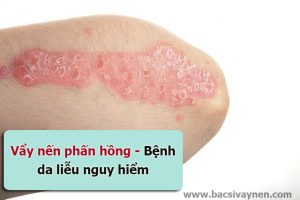 Bệnh vẩy nến phấn hồng