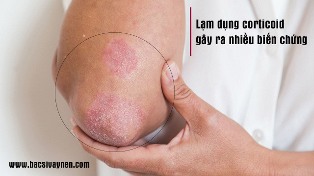 Thận trọng khi dùng Corticoid chữa bệnh vẩy nến