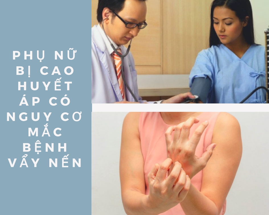 Phụ nữ cao huyết áp có nguy cơ mắc bệnh vẩy nến