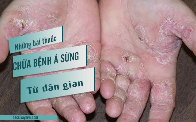 Chữa bệnh á sừng bằng dân gian