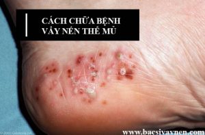 cách chữa bệnh vẩy nến thể mủ