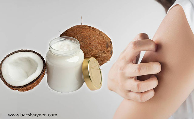 Chữa bệnh vẩy nến bằng dầu dừa