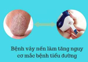 bệnh vẩy nến làm tăng nguy cơ mắc bệnh tiểu đường