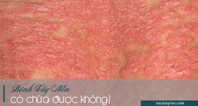 Bệnh vẩy nến có chữa khỏi được không?