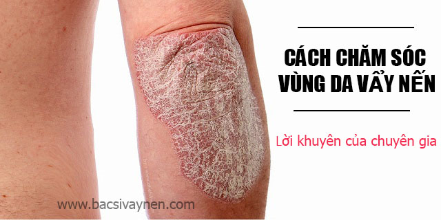 Cách chăm sóc vùng da bị vẩy nến đúng cách