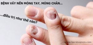 điều trị bệnh vẩy nến móng tay, móng chân