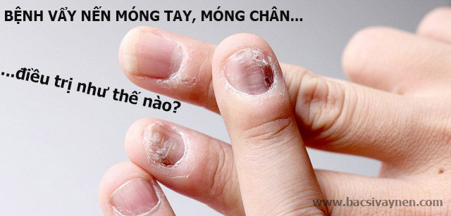 Điều trị bệnh vẩy nến móng tay, móng chân