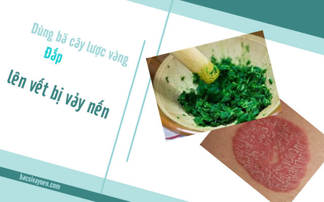 Giã lá cây lược vàng để đắp nên vết vẩy nết