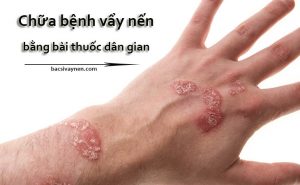 Bài thuốc dân gian chữa bệnh vẩy nến