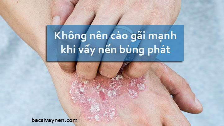 Những điều cần lưu ý khi điều trị vẩy nến