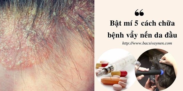 Cách chữa bệnh vẩy nến da đầu