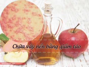 chữa vảy nến bằng giấm táo