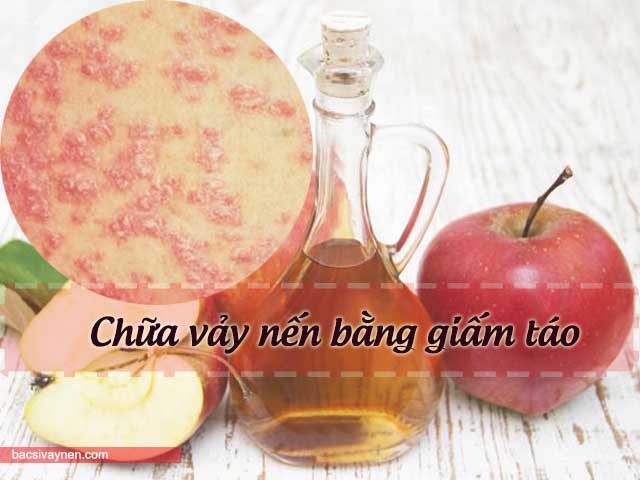 cách chữa vẩy nến bằng giấm táo