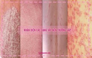 nhận biết các thể của bệnh vẩy nến