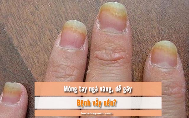 móng tay bị gãy và ngả vàng có phải là bệnh vẩy nến