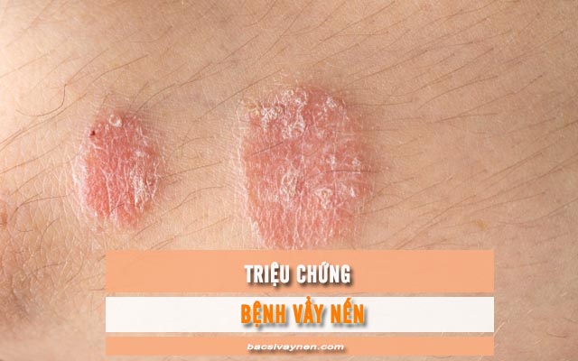 triệu chứng của vẩy nến