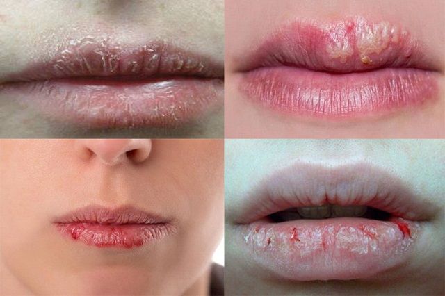 Hình ảnh chàm môi gây khô, bong tróc, nứt nẻ