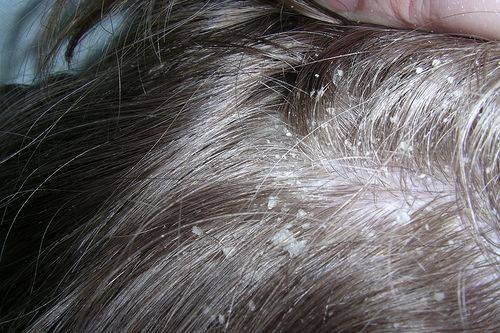 Phân biệt bệnh nấm da đầu và bệnh vẩy nến da đầu