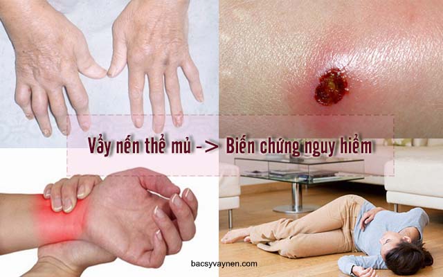 biến chứng của bệnh vẩy nến thể mủ