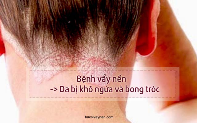 da bị ngứa và khô ráp là biểu hiện của bệnh gì