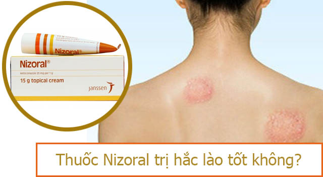 thuốc Nirozal trị hắc lào