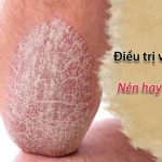 có nên điều trị vẩy nến tại nhà không