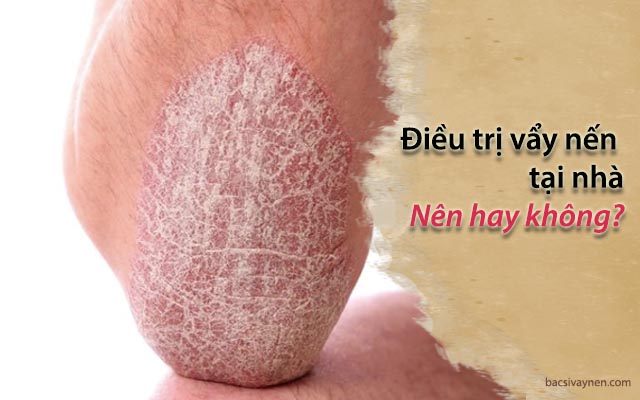 có nên điều trị vẩy nến tại nhà không