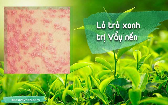 Chữa bệnh vẩy nến bằng lá trà xanh