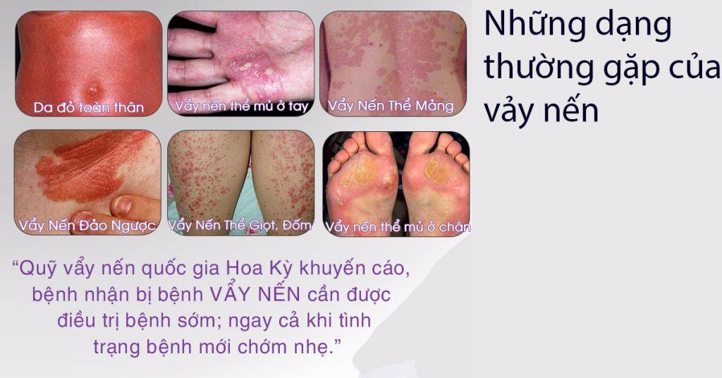 Thuốc chữa vẩy nến từ Đông y
