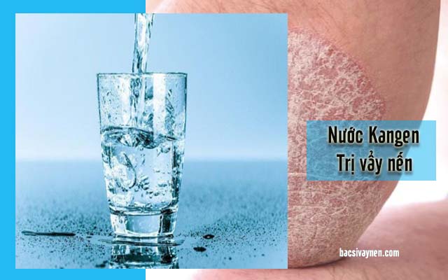 nước Kangen trị vẩy nến tốt không