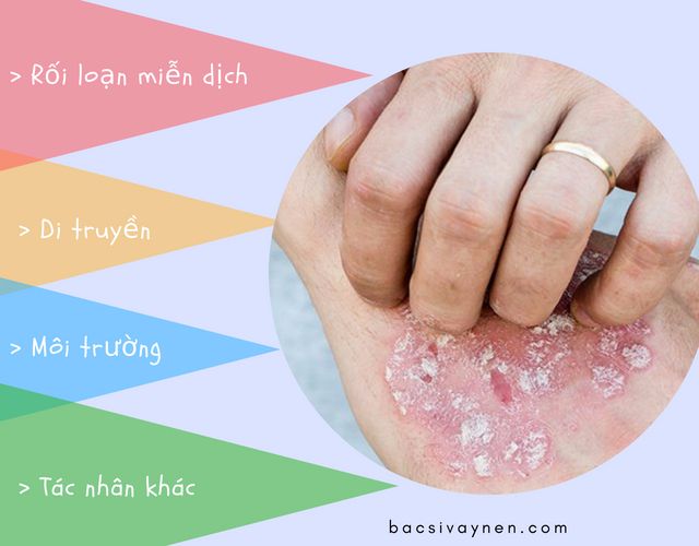 Nguyên nhân gây bệnh vẩy nến