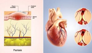 Biến chứng bệnh vẩy nến