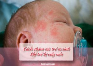 cách chăm sóc trẻ sơ sinh bị vẩy nến