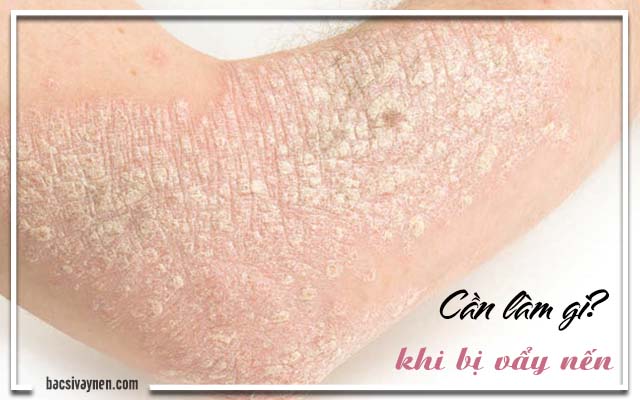 cần lưu ý gì khi mắc bệnh vẩy nến