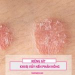 vẩy nến phấn hồng kiêng những gì