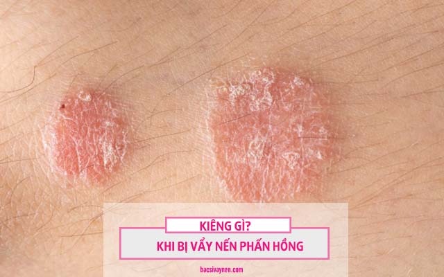 vẩy nến phấn hồng kiêng những gì