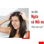 da đầu ngứa ngáy và nổi mụn trứng cá