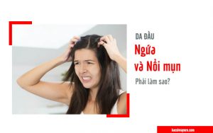 da đầu ngứa ngáy và nổi mụn trứng cá