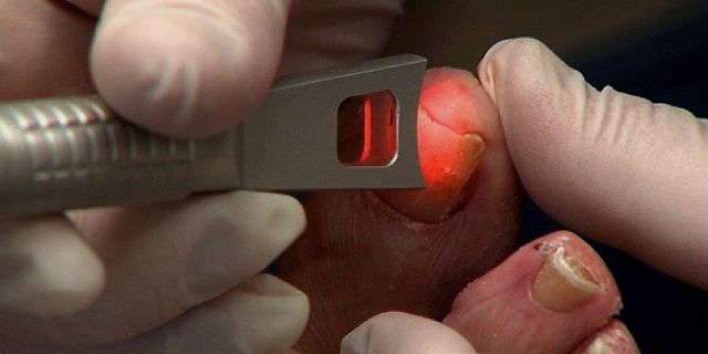Chữa bệnh á sừng ở chân bằng công nghệ laser
