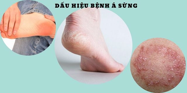 Dấu hiệu nhân biết bệnh á sừng ở chân