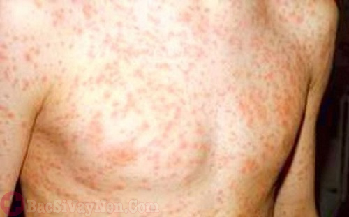 Triệu chứng HIV gây phát ban trên da, đỏ ửng chủ yếu trên vùng ngực
