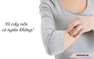 bệnh vẩy nến có ngứa không