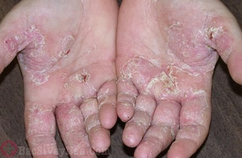 Bệnh á sừng ở bàn tay