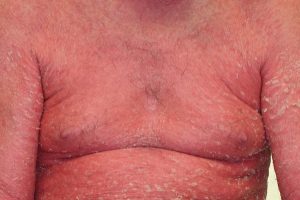 Bệnh vảy nến thể đỏ da đỏ toàn thân