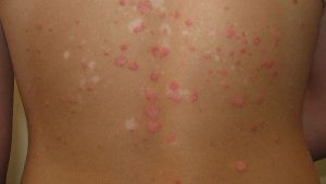 Bệnh vảy nến ở lưng