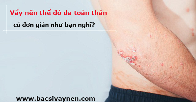 Bệnh vẩy nến thể đỏ da toàn thân