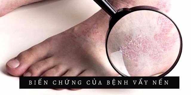 Một số biến chứng của bệnh vẩy nến