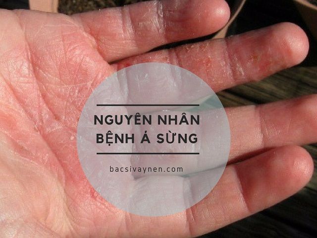 Nguyên nhân gây bệnh á sừng